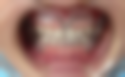 在决定是否选择70岁老人种植牙前，普通用户更容易忽略的关键评估点及医院医生推荐