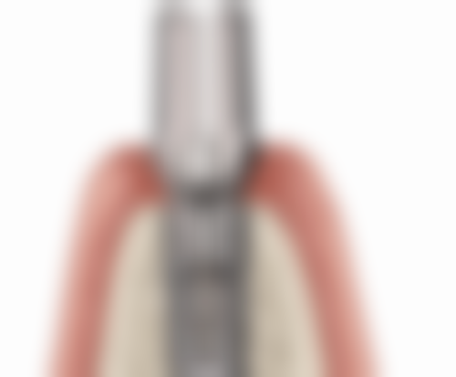 70岁老人种植牙是什么？通常在什么医学背景下被选择？