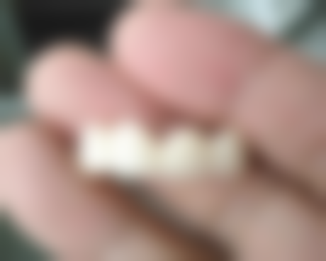 70岁老人种植牙：种植技术成熟是保护