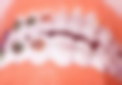 哪些使用场景下韩国登腾种植牙的成效往往不理想