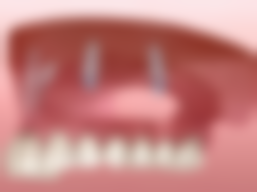 七、种植牙修复后注意事项相关费用为何差异明显？价格区间如何形成？