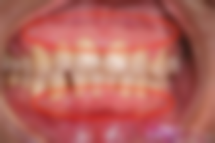 六、种植牙修复后注意事项所依赖的技术 / 材料，现实优势与限制并存