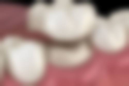 在决定是否选择干燥综合征种植牙前，普通用户更容易忽略的关键评估点