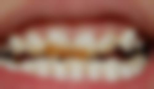 干燥综合征种植牙本身能解决什么、不能解决什么