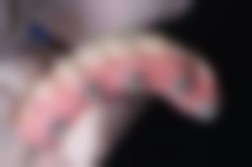 干燥综合征患者唾液分泌问题的医学分析