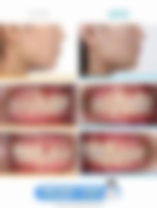 卡尔斯种植体单颗价格为何在3000 - 8000元