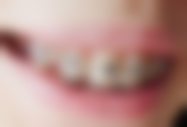 20岁成年人牙齿矫正要多久?成人正畸一般需要1.5 - 3年