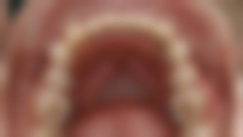 地包天牙齿矫正成效不理想后的补救与修复空间