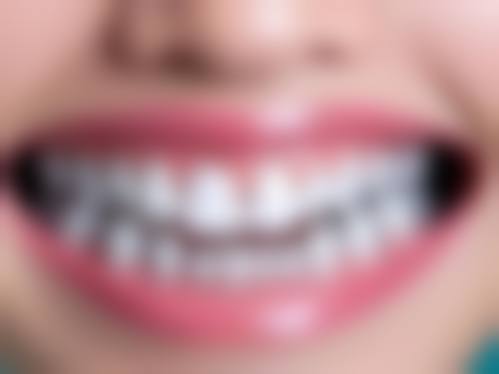 瑞士ITI种植牙的稳定性体现