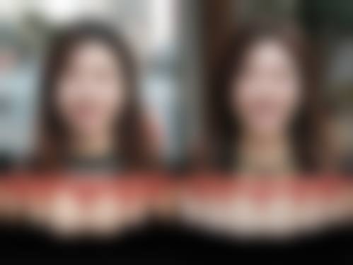 5岁儿童牙齿地包天矫正价格究竟是怎样的？