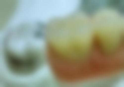 瑞典诺贝尔种植体优点