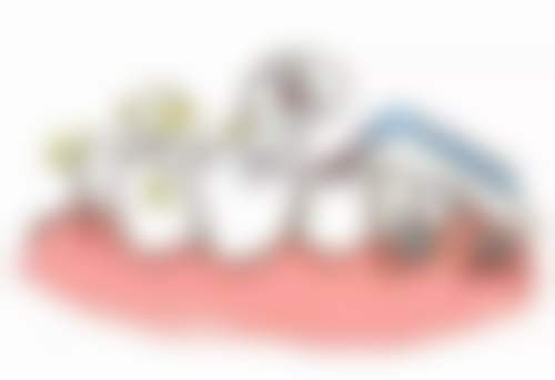 种牙牙冠粘接牢固吗？解答你的疑虑