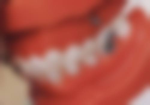 种植牙冠粘接步骤全解析