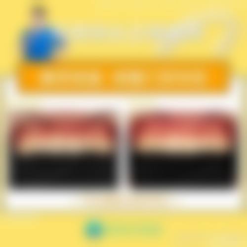 儿童补牙需要全麻吗？轻微龋齿无需全麻，仅复杂多牙情况约10%需全麻！全麻补牙费用3000-8000元，安全可靠，一次性解决多颗龋齿问题