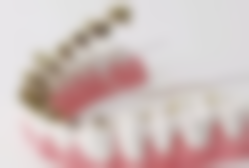 活动假牙与种植牙哪个好？种植牙超10年耐用稳固，活动假牙几百元但易松动！答案揭晓 