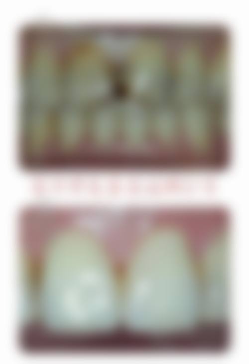 全口种植牙性价比高体现在哪些方面？