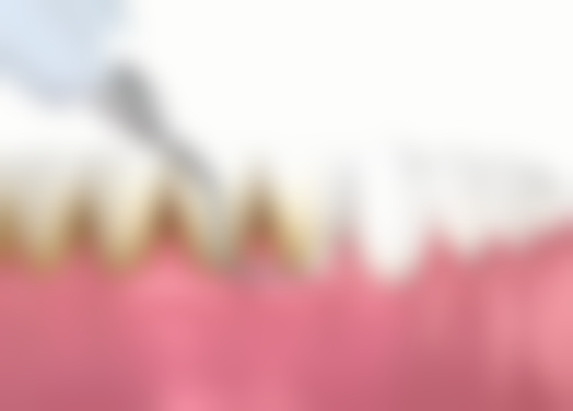 深入解析：活动假牙和种植牙的优缺点，看完不再纠结