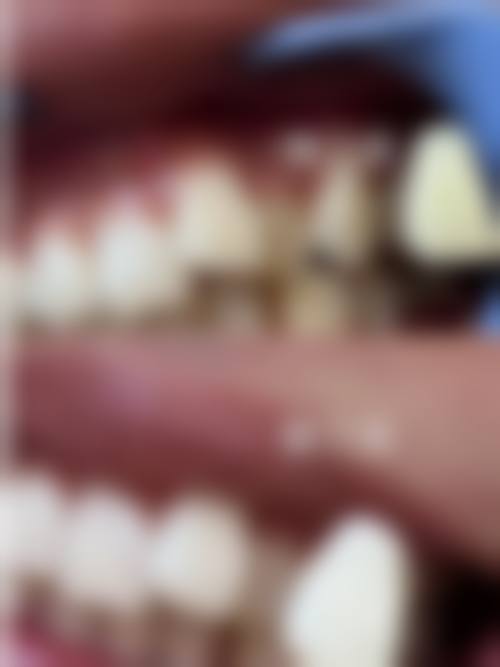 时代天使kidk1正畸成效怎么样？真实实例，见证奇迹