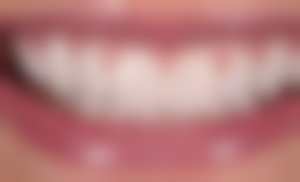 不同时间段种植牙的成效对比