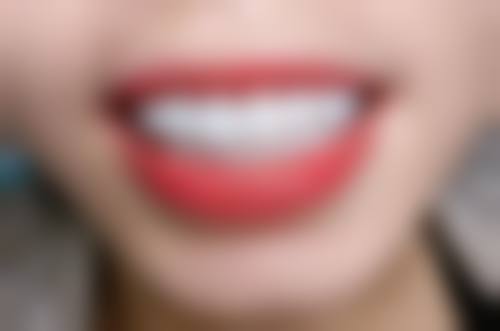 哪种牙齿矫正需要拔牙？牙列严重拥挤、龅牙及咬合异常矫正多需拔牙，原因全揭秘！ 