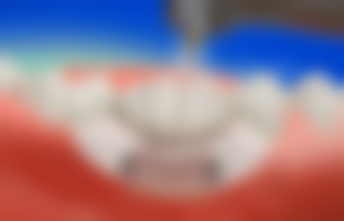 全口种植牙究竟可以使用多长时间？正常维护下能用10 - 20年甚至更久！原因在这里  全口种植牙费用几何？种植颗数又该如何确定？