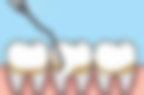 如何判断种植牙报价是否合理