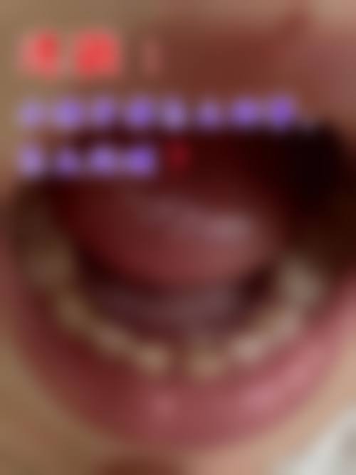 东莞吸附性义齿哪里能做？这几家靠谱医院价格与医保情况全解析