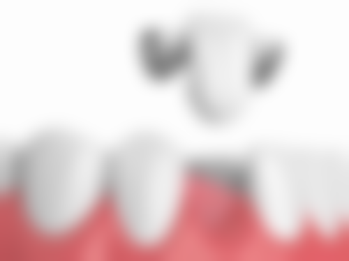 儿童补门牙用什么材料好？让我来告诉你