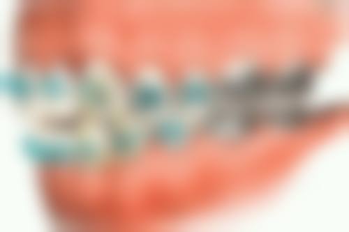 青岛维乐美口腔黄岛总院矫正实例成效好吗？真人实例见证改变