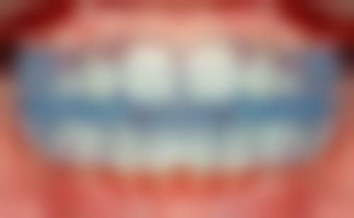 7岁地包天矫正所需时间评估