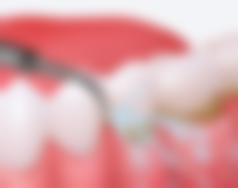 儿童门牙补牙材料及费用大揭秘