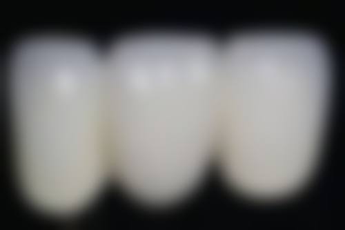 香港 種植牙過程 適合邊類人群？唔係人人都啱做！