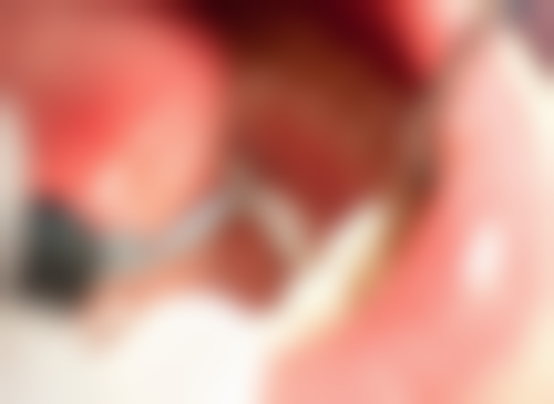 香港 珠海做根管治療多少錢 醫保報銷攻略