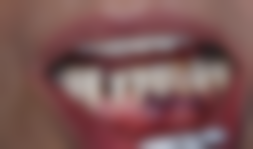 香港 大陸種牙幾多錢 適合邊類人群？