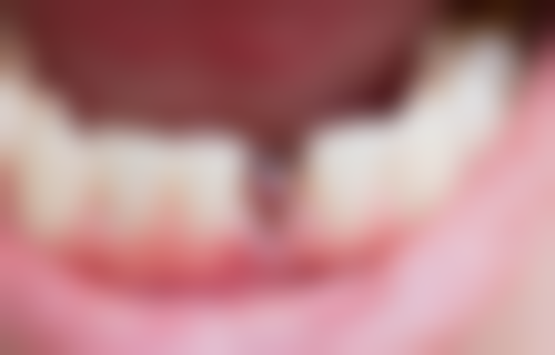 香港 大陸種牙幾多錢 真實实例：3個港人北上體驗