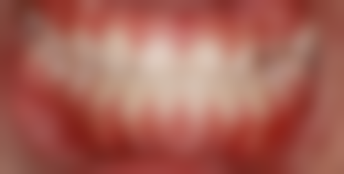 香港 澳门牙科医院哪个好 种牙悭70%攻略:5个实用tips