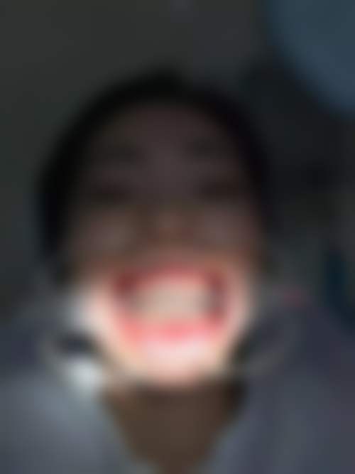 20岁矫正牙齿有哪些优缺点？