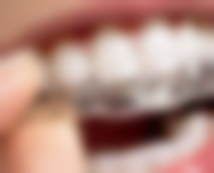 拓展延伸：種植牙常見疑問+避坑指南