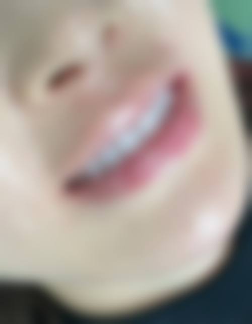 冷光牙齿美白仪的价格区间是多少？