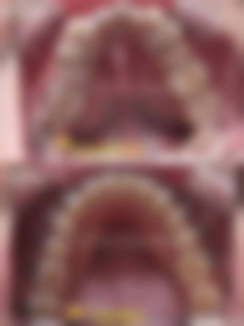 儿童牙龈肿拔牙后成效如何？受哪些因素影响？