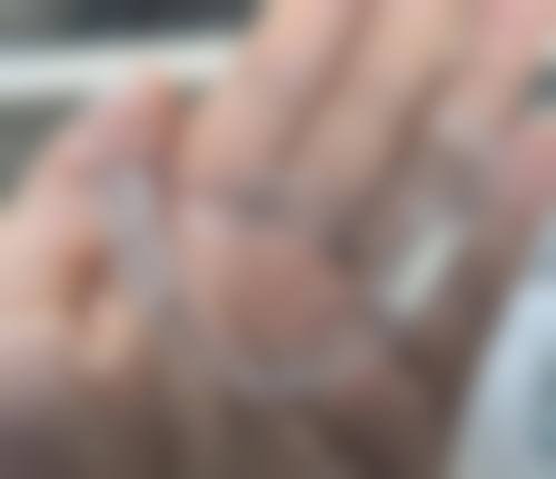 6岁地包天牙齿矫正费用大概是多少?受哪些因素影响?