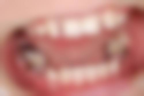 深圳格倫菲爾牙科好唔好 拓展延伸：香港人過深圳整牙必知3件事