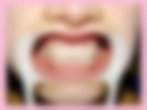 拔牙后即刻种植的情况