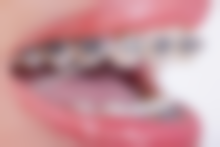 嘴巴歪牙齿矫正常见并发症或后遗问题，在临床中如何理解其发生概率？