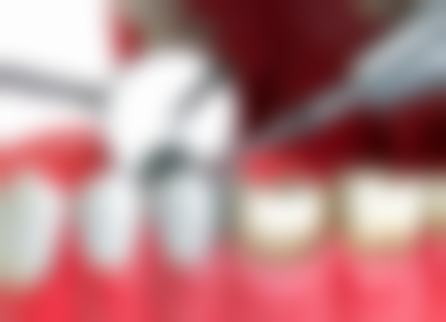 香港 麥芽口腔免費洗牙 技術好唔好？真人实例話你知