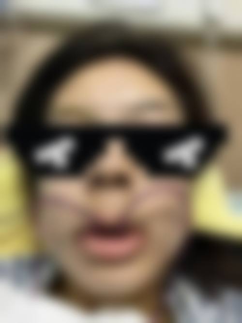 儿童地包天矫正成效预期的真实边界