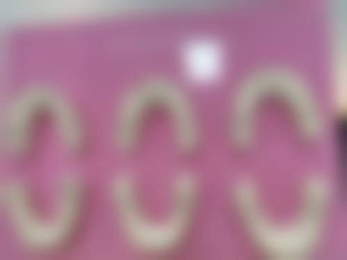 七岁儿童换牙地包天矫正本身能解决什么、不能解决什么？