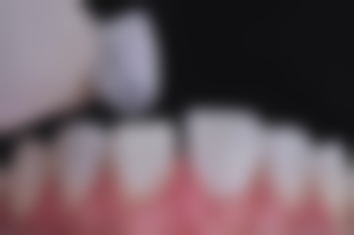 集采种植牙大概多少钱