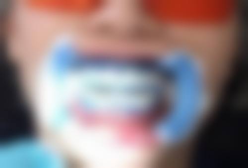 种植牙哪个国内的更好且价格合理