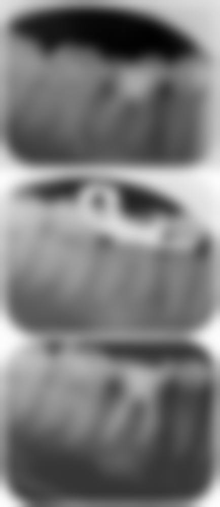 香港姊妹做澳门牙齿根管治疗术前术后避坑指南